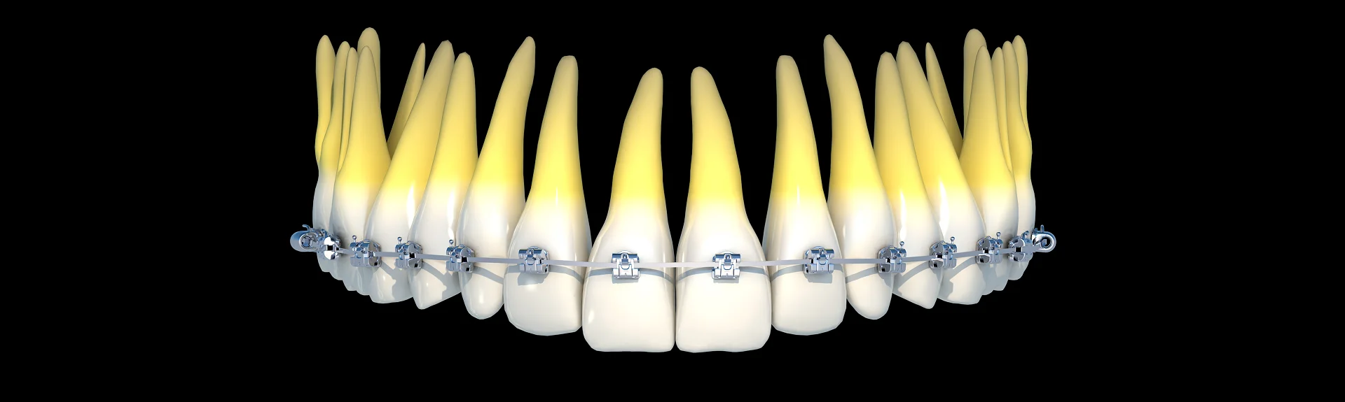 SureSmile orthodontic technology