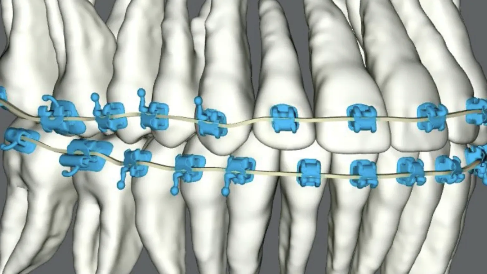 SureSmile orthodontic technology